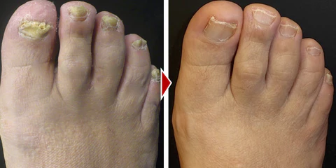 TOENAIL SERUM | JAPANESE ANTI-FUNGAL FORMULA | REGENERATES & STRENGTHENS | 1+1 FREE